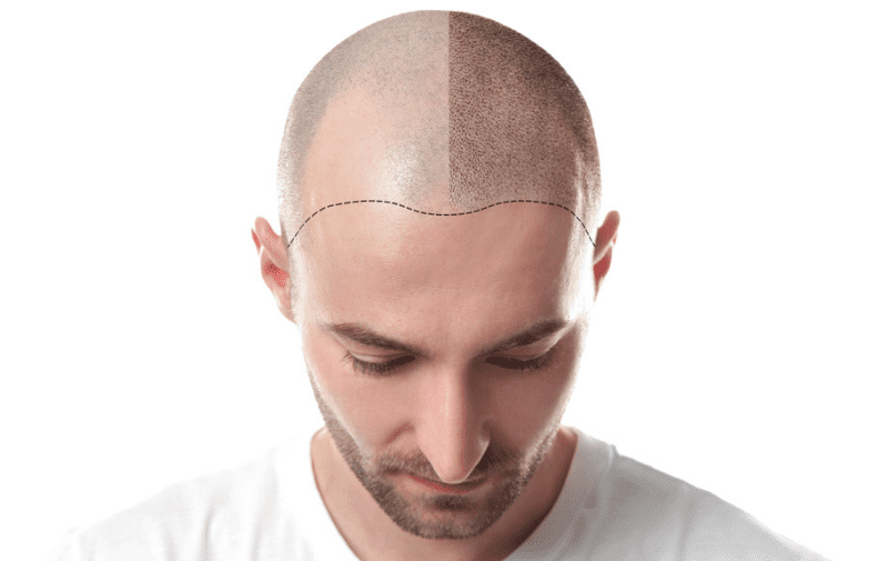 Important things you should know before planning a hair transplant   Pristyn Care